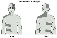 Shingles, Figure 1