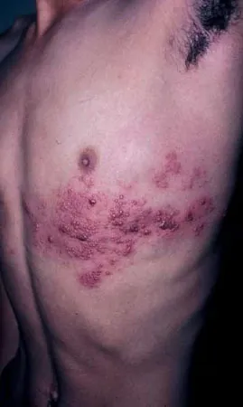 Shingles, Photo 1