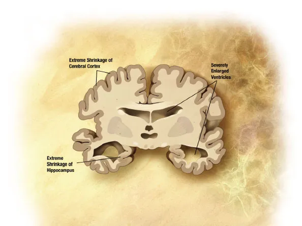 advanced Alzheimerís brain shrinks