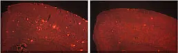 Amyloid plaque