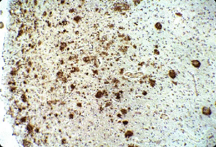 Beta-Amyloid Deposits