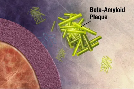Beta-Amyloid plaque