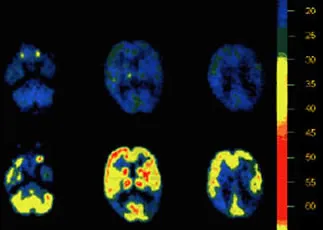PET scans