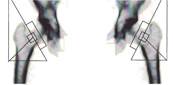 DEXA Hip Scan