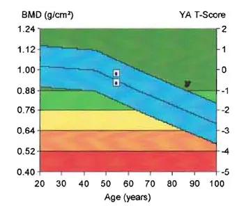 Mary's DEXA results