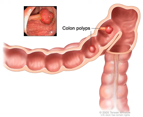 Colon Polyps