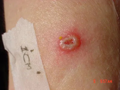 smallpox vaccine mark