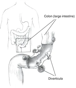 Illustration of the colon (large intestine) and an enlargement of it showing diverticula.