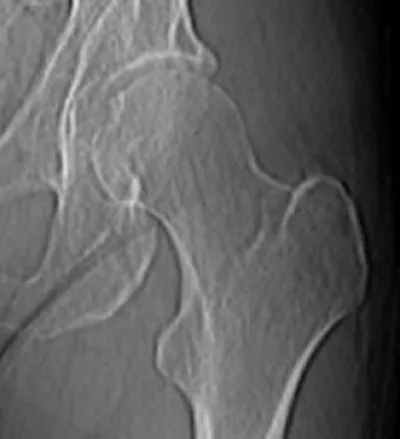 A Hip Joint of a Heavy Equipment Operater