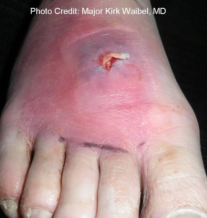 Invasive Infection