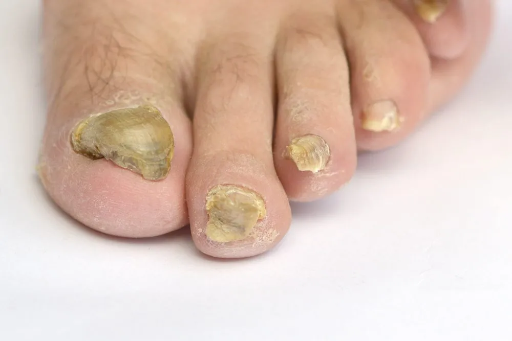 Fungal toenails with discoloration and thickened texture, illustrating symptoms of onychomycosis, relevant to foot health discussions at Brisbane Foot Clinic.