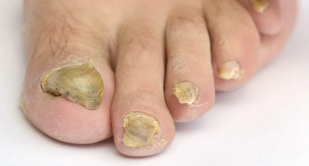 Fungal toenails with discoloration and thickened texture, illustrating symptoms of onychomycosis, relevant to foot health discussions at Brisbane Foot Clinic.