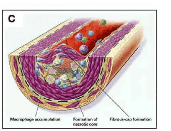 Artery hardening