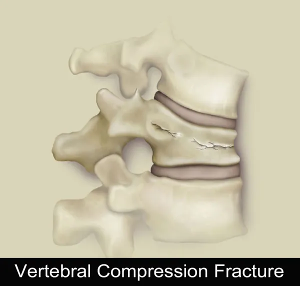 vertebral compression fracture