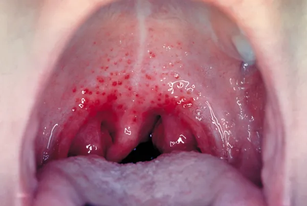 Sore Throat