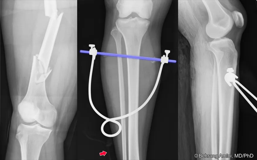Pin in Tibia