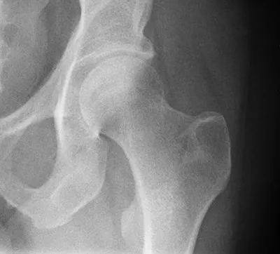 A Normal Hip Joint