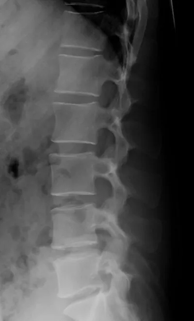 Normal Intervertebral Spaces