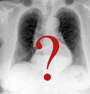 X-RAY