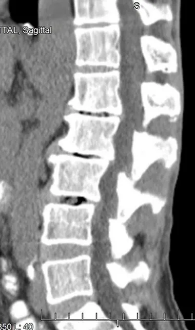 The skier's X-ray