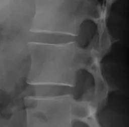 Spine X-ray