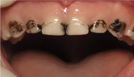 Stained Teeth photo courtesy of Daniel Raether, D.D.S.