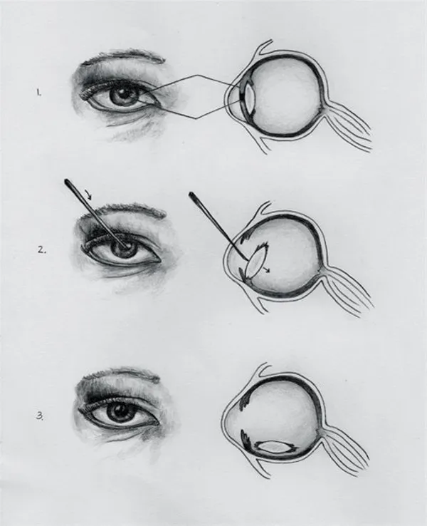 Traditional Eye Practices